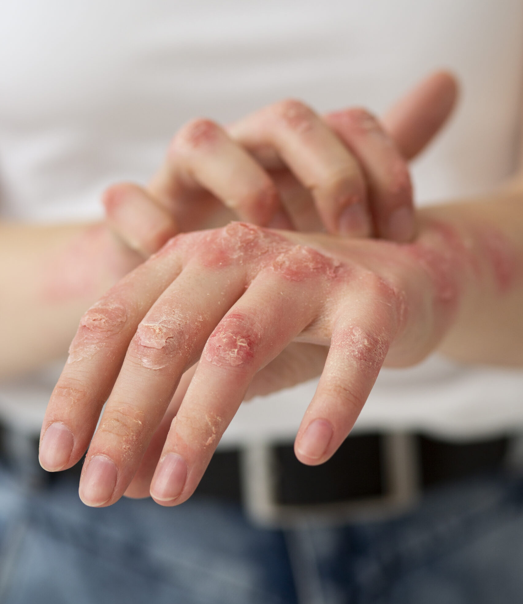HOMEOPATHIC MEDICINE FOR PSORIASIS