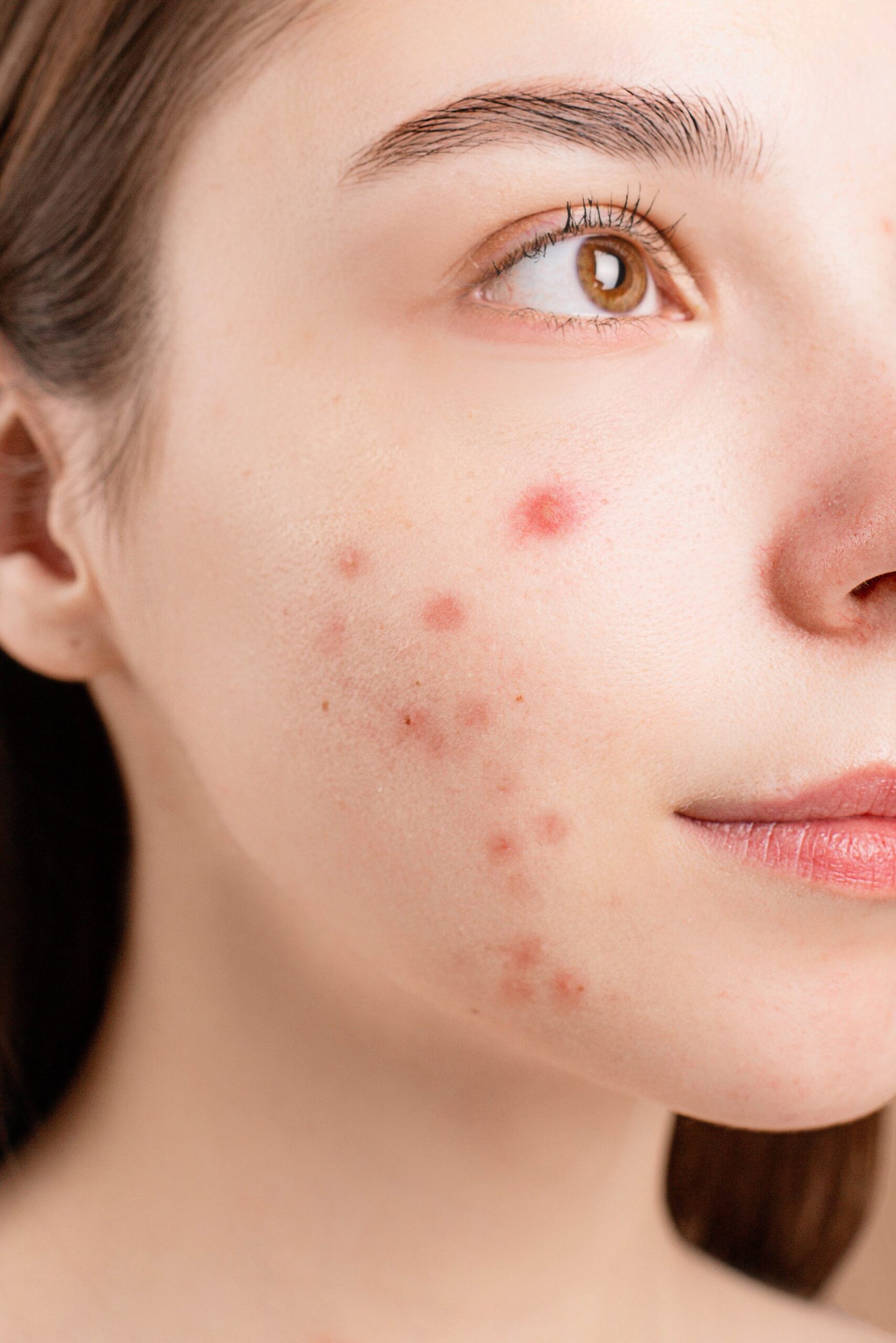 Best Homeopathic Medicine For Acne