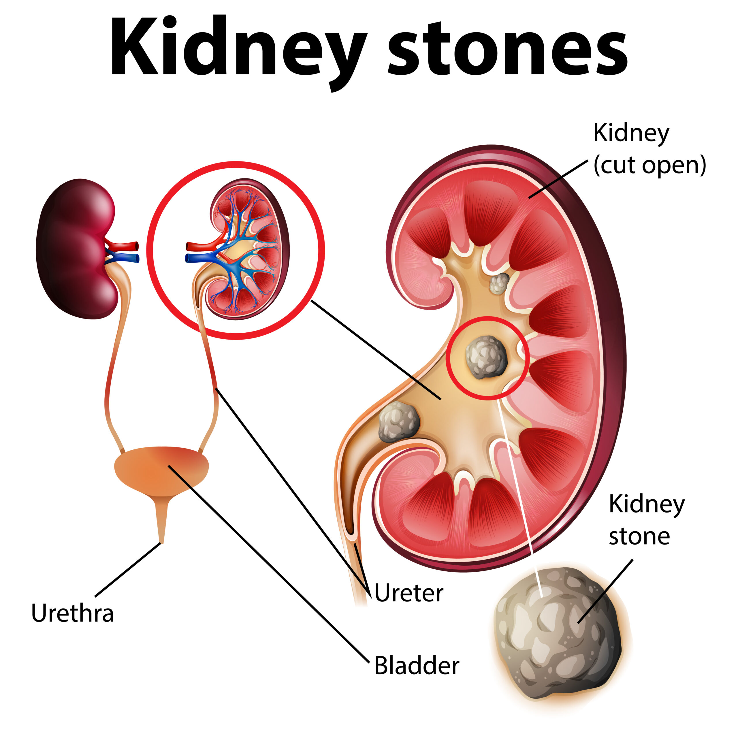 Homeopathic Medicine for Kidney Stone