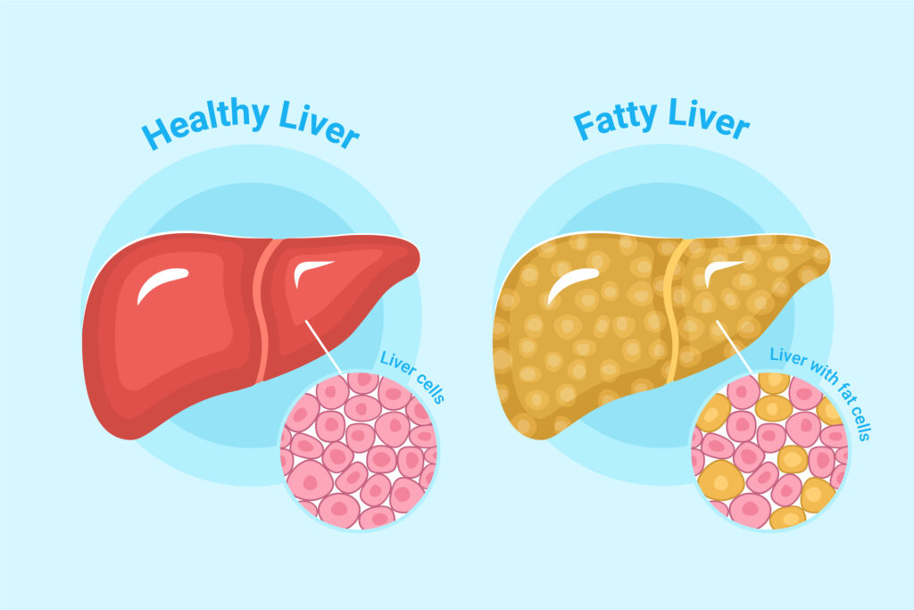 Homeopathic Medicine For Fatty liver