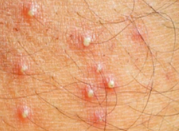 Homeopathic Medicine for Folliculitis