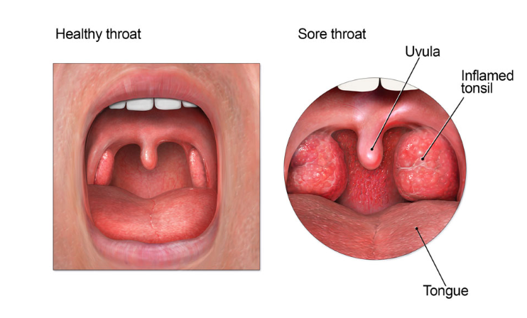 Homeopathic Medicine For Tonsil 