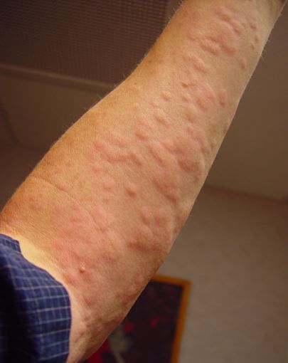 Homeopathic Medicine For Urticaria